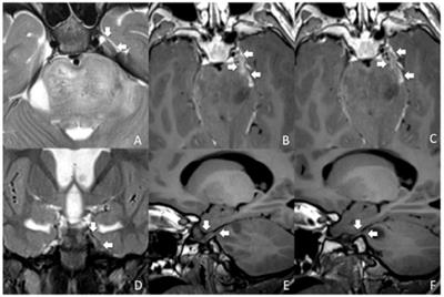 Direct Involvement of Cranial Nerve V at Diagnosis in Patients With Diffuse Intrinsic Pontine Glioma: A Potential Magnetic Resonance Predictor of Short-Term Survival